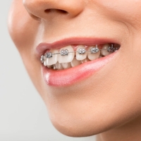 Dental Braces