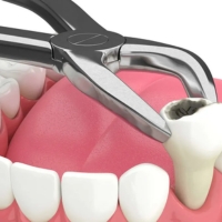 Dental Extraction