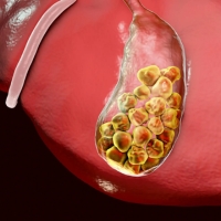 Gall Bladder Stones