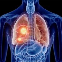 Lung Cancer Screening Diagnosis