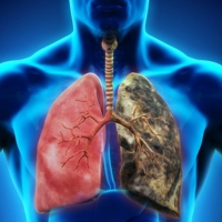 Lung Diseases