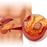 Pancreatitis