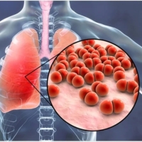 Pneumonia Lung Infections
