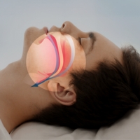 Sleep Apnea - Snoring Issues