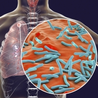 Tuberculosis (TB)
