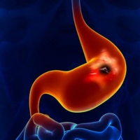 Ulcer in Stomach